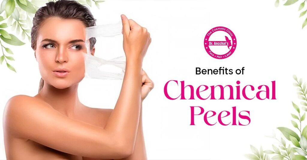 Benefits of Chemical Peels